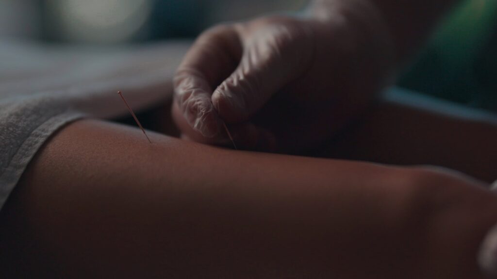Dry needling treatment by a physio in Cromer